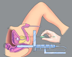 Brachytherapie - Abb. mit freundlicher Genehmigung der Fa. Oncura