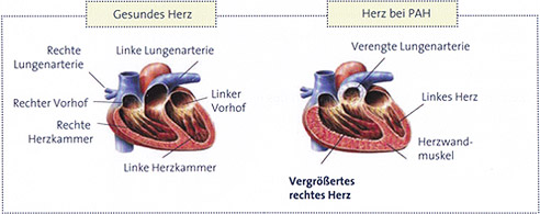 Pulmonale arterielle Hypertonie (PAH)